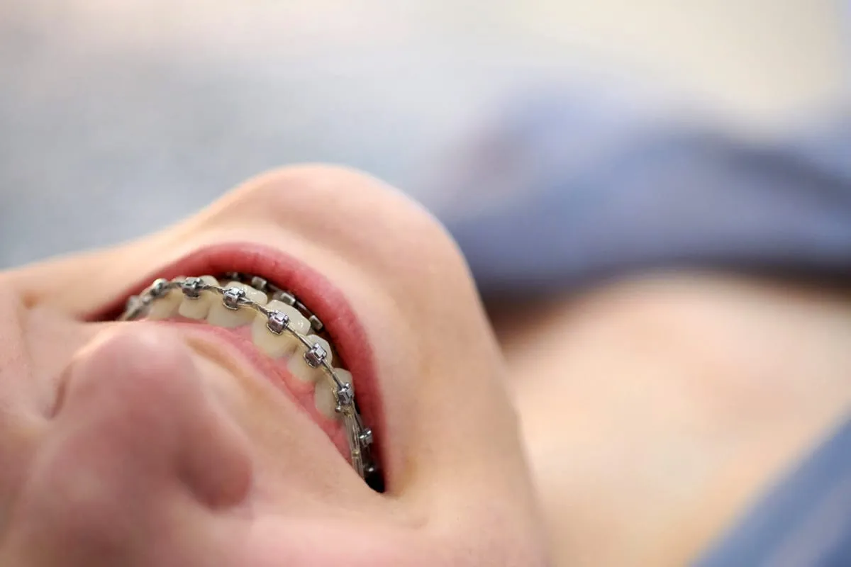 What to Expect From Traditional Braces in Memphis