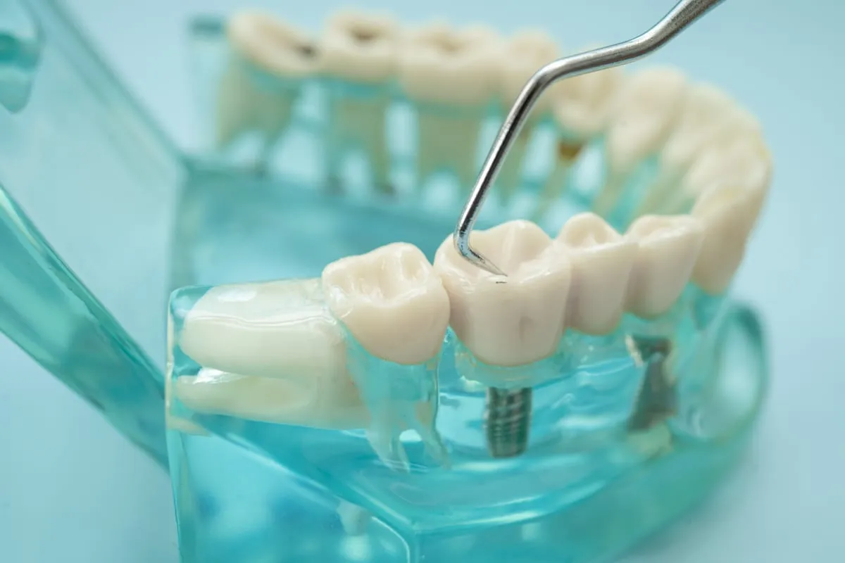 Dental Fillings: What to Expect, Materials & Aftercare