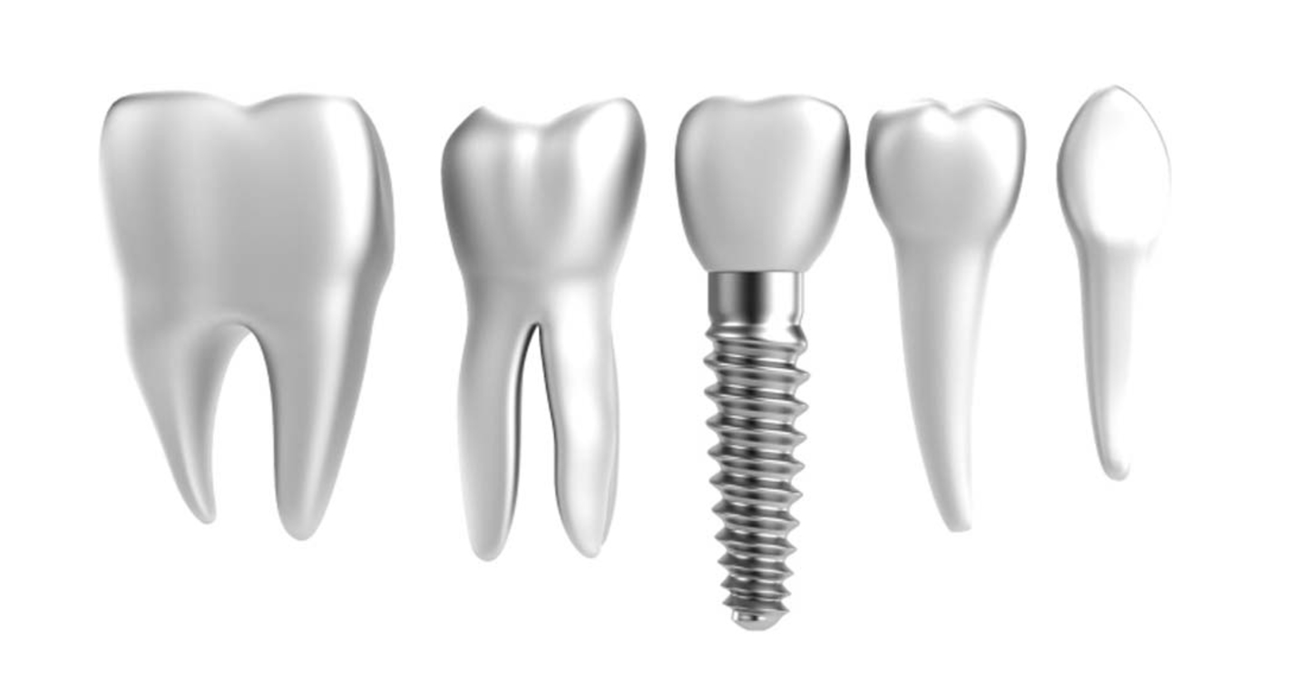 Răng sứ Zirconia - Tất tần tật về răng sứ Zirconia năm 2023